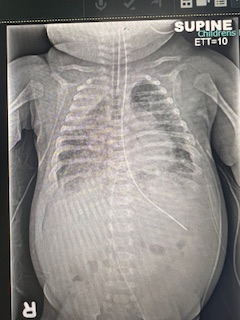 Neonatal xray2