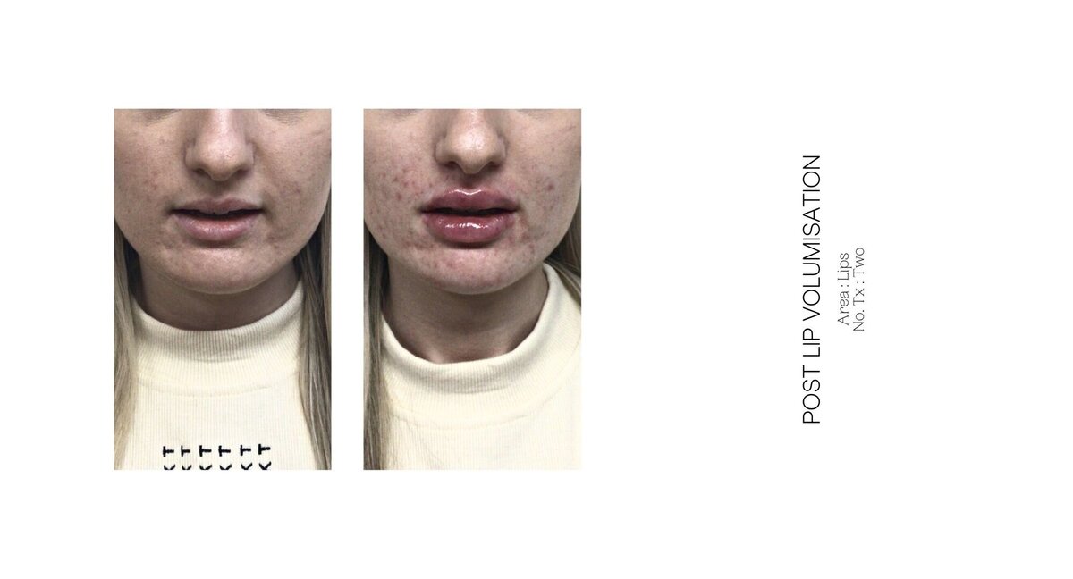 Best South Coast Lip Injection Before and After 22