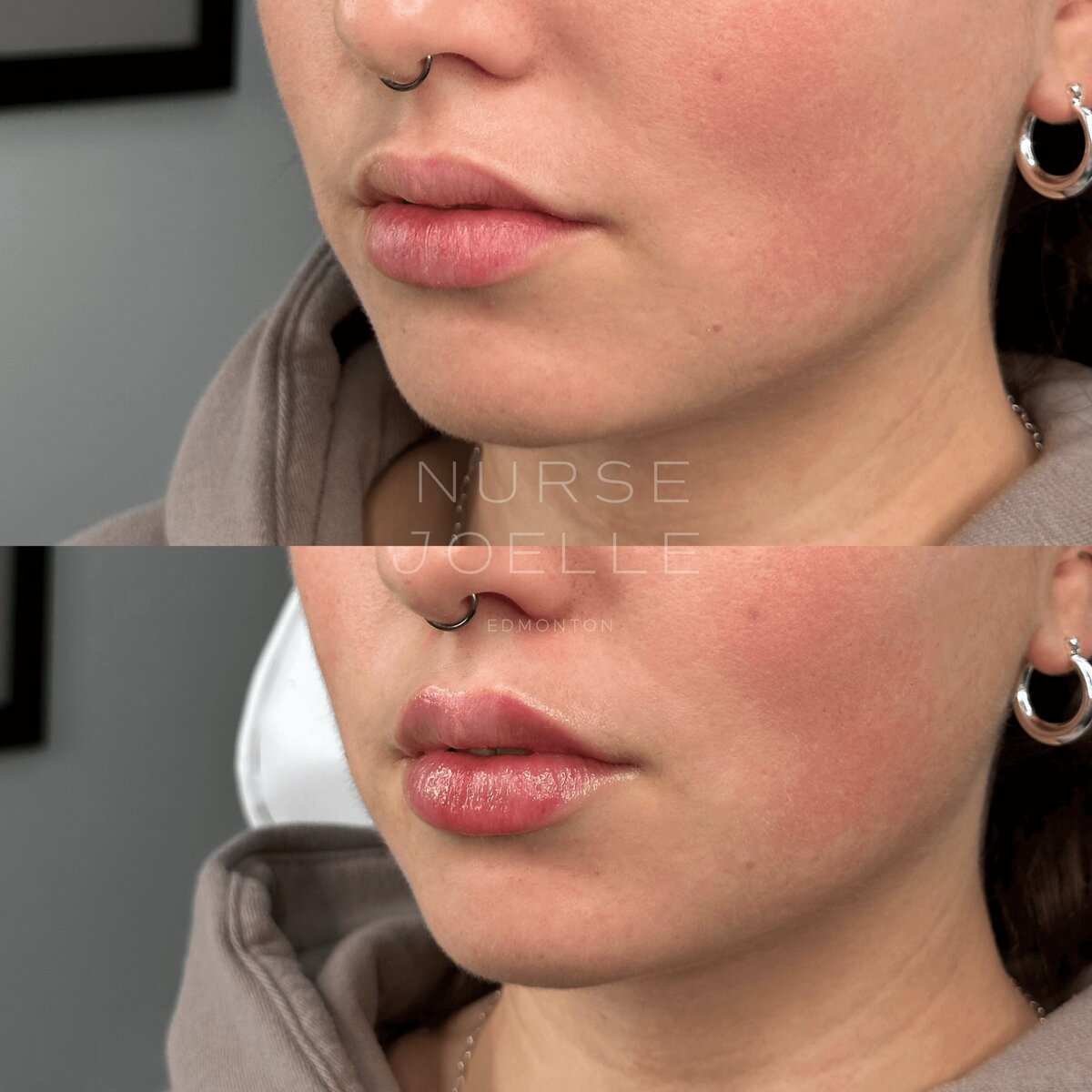 Nurse-Joelle-Cosmetic-Injectables-Before-and-After-14