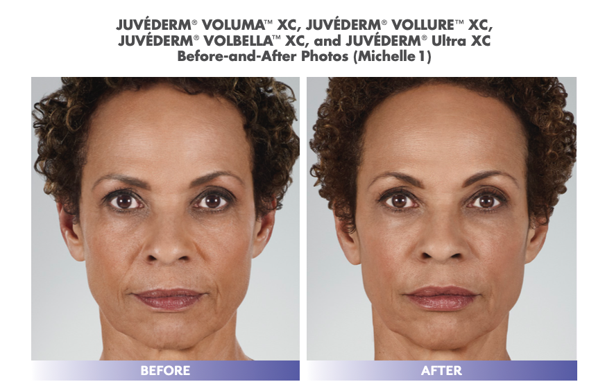 Juvederm_Treatment_female