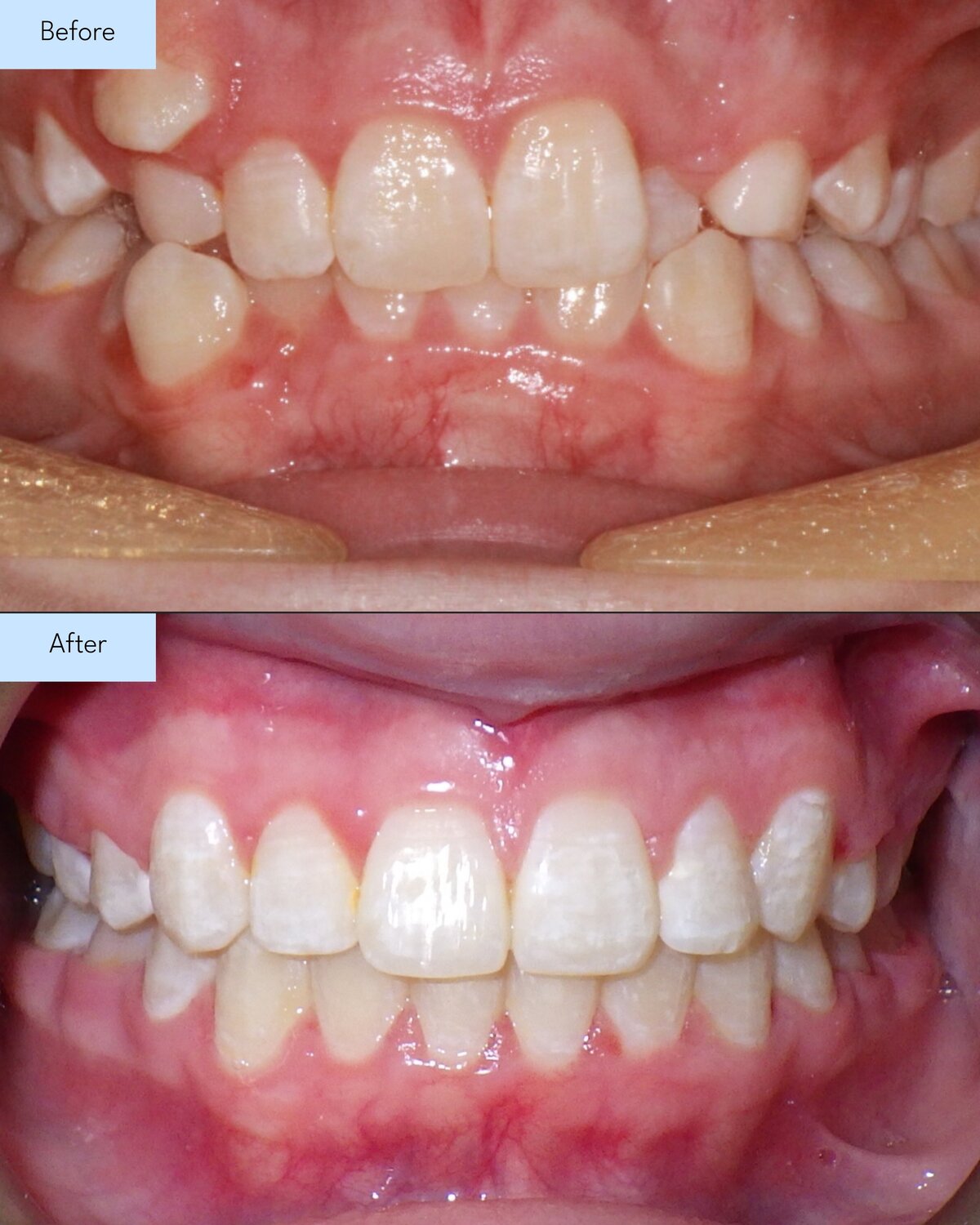 Before and after of Brooks & Templeton Orthodontics patient teeth transformation