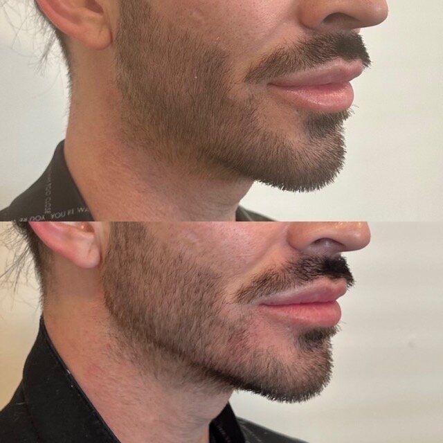 Jawline Filler with Volux