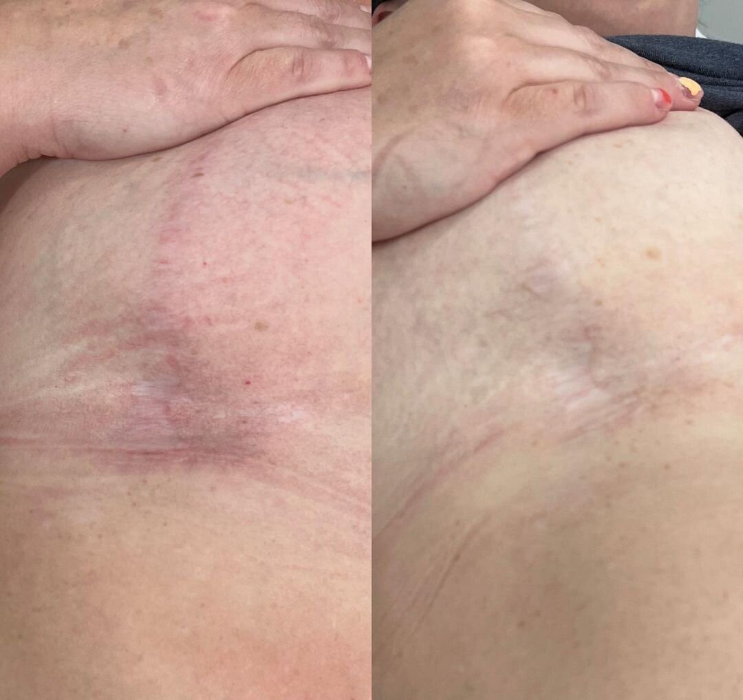 Scar Reduction - Photo Courtesy of Georgia Edlingg & Kristen Shimp, NP - 2
