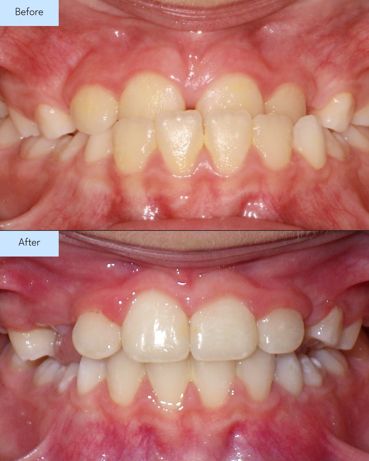 Before and after of Brooks & Templeton Orthodontics patient teeth transformation