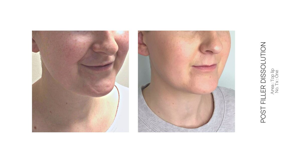Top Lip Filler Dissolve Before and After 6