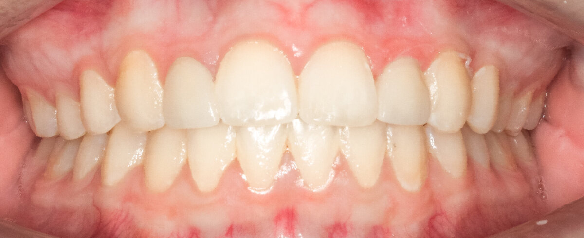 thrive dental veneers