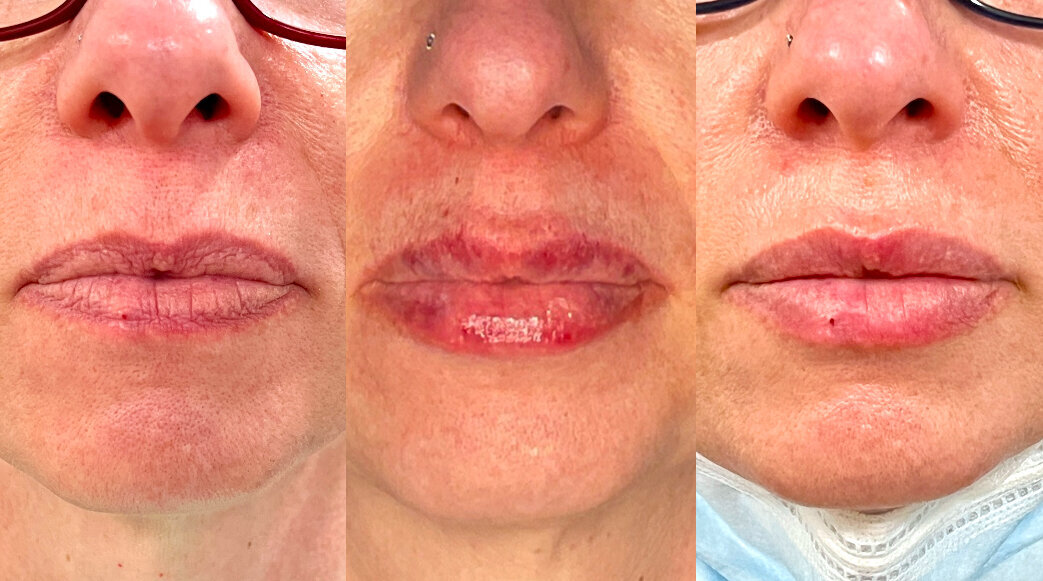 lip filler pre, immediately post, and day 10