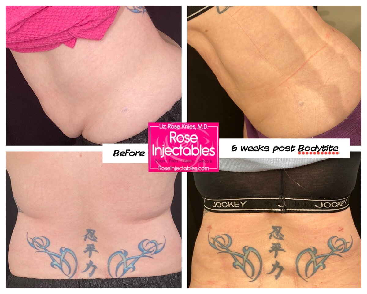 BodyTite-by-Rose-Injectables-Minimally-Invasive-Body-Contouring-Before-and-After-Photos-60