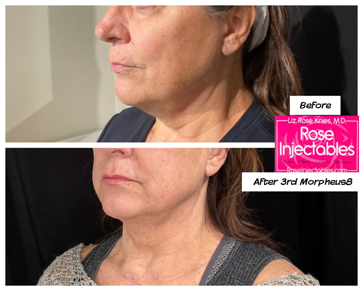 Morpheus8-by-Rose-Injectables-Before-and-After-Photos-11