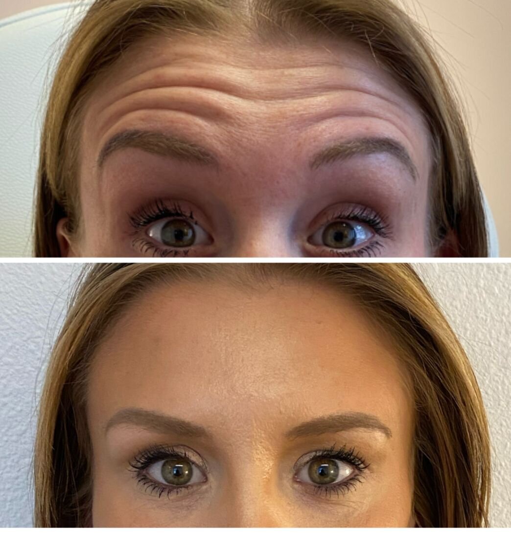 compressed-Neuromodulator-before-after-05