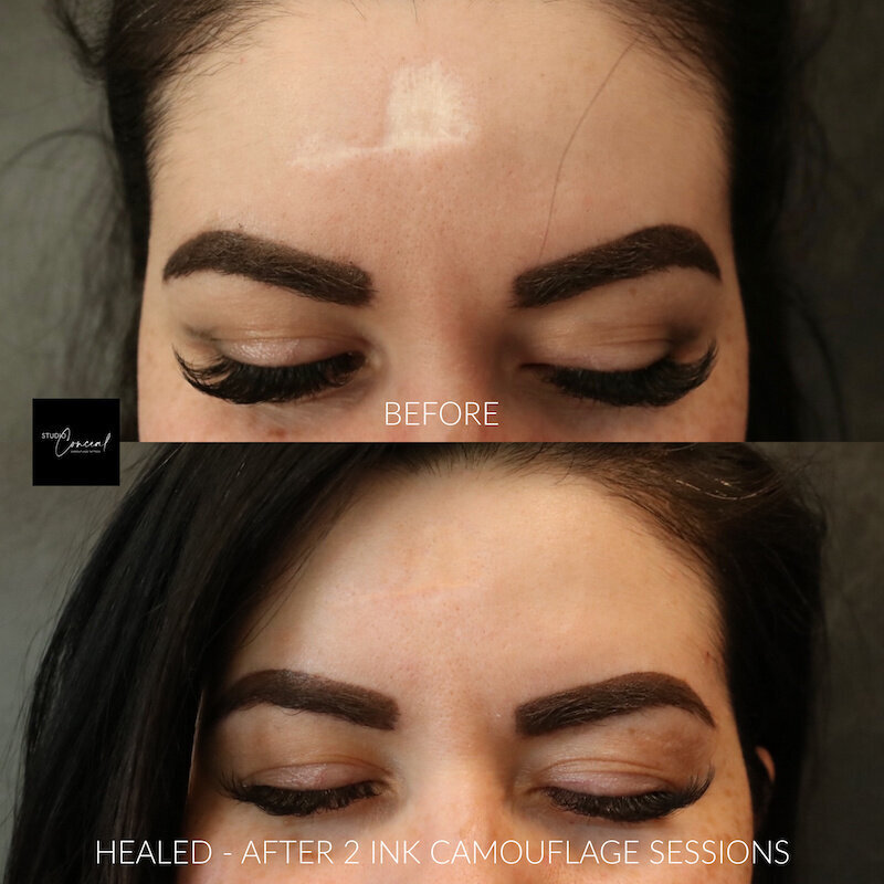 forehead-burn-scar-removal