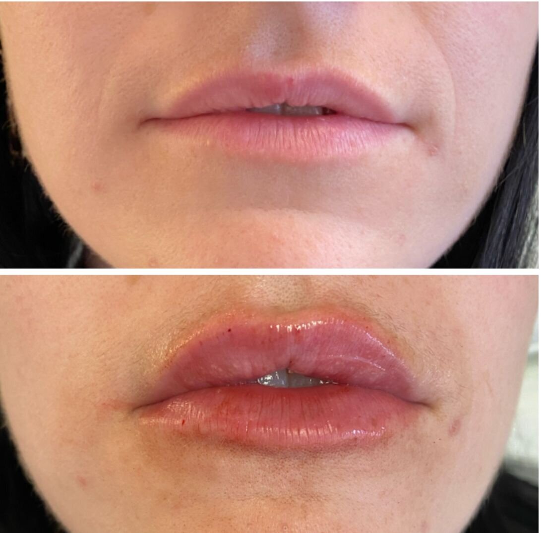 compressed-Lip-Wrinkles- Lip-volume-nd-some-brand-pics-08