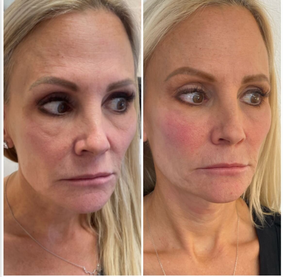 compressed-sculptra-before-after-05