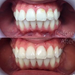 llings20in20three20upper20front20teeth20to20even20color20and20alignment.JPEG