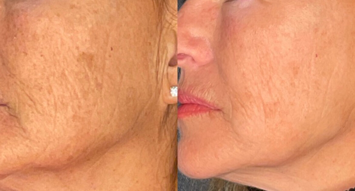 incredible results after one light and bright treatment with the Candela Nordlys.  Combining IPL photorejuvenation with non-ablative frax resurfacing