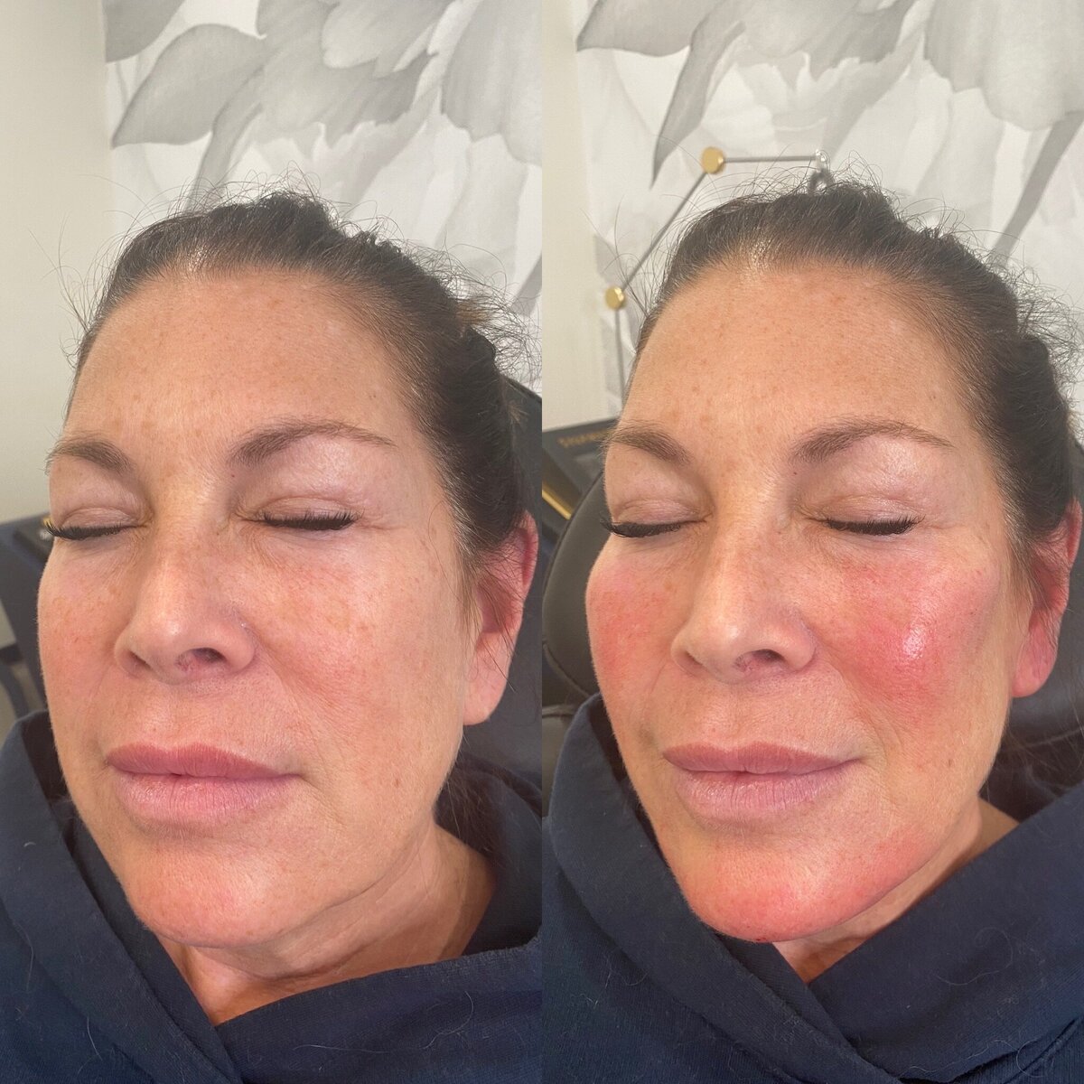 BalancedBeautyBotoxWestwood3