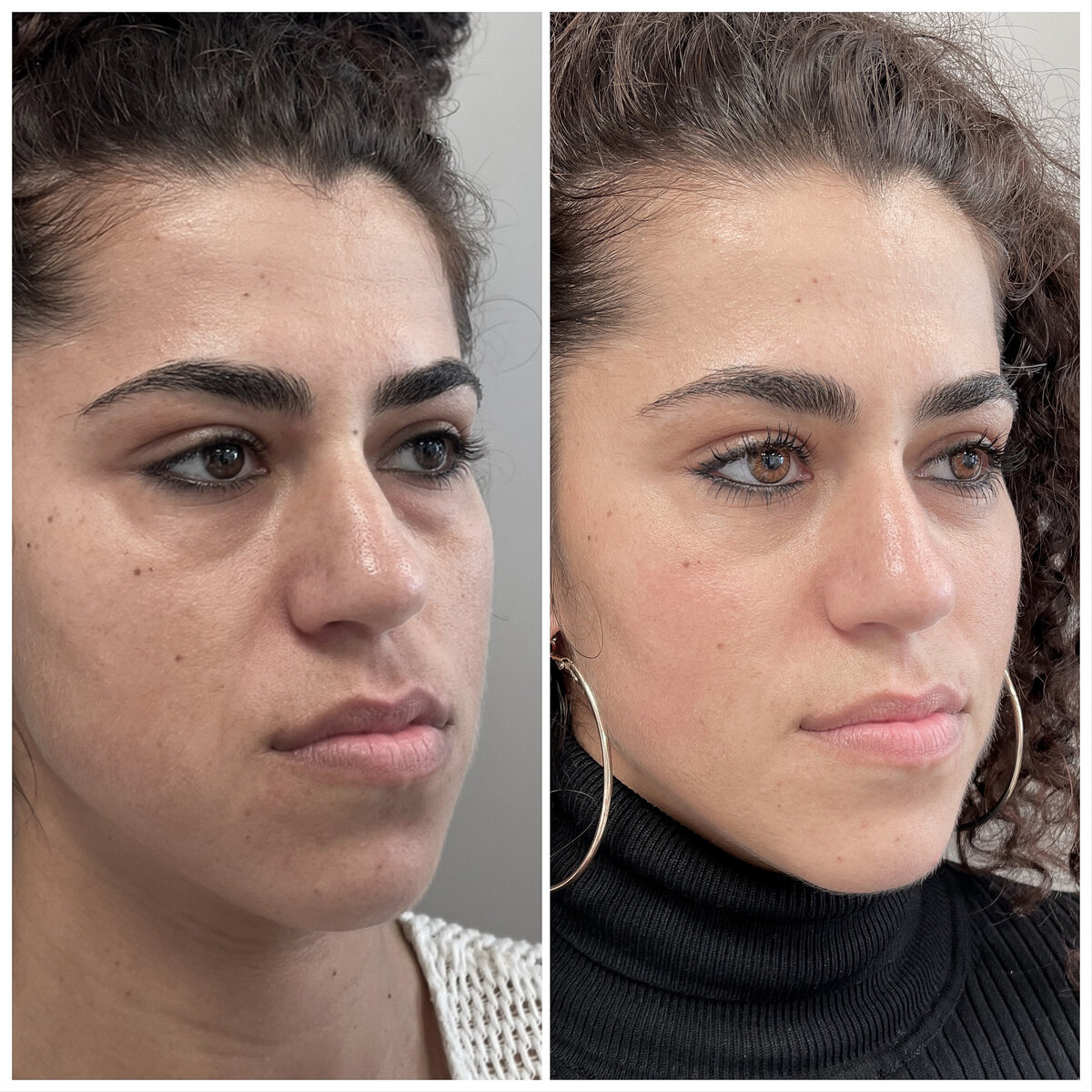 Before after fillers door Dr Lizenka Adriaanse cosmetisch arts Rotterdam