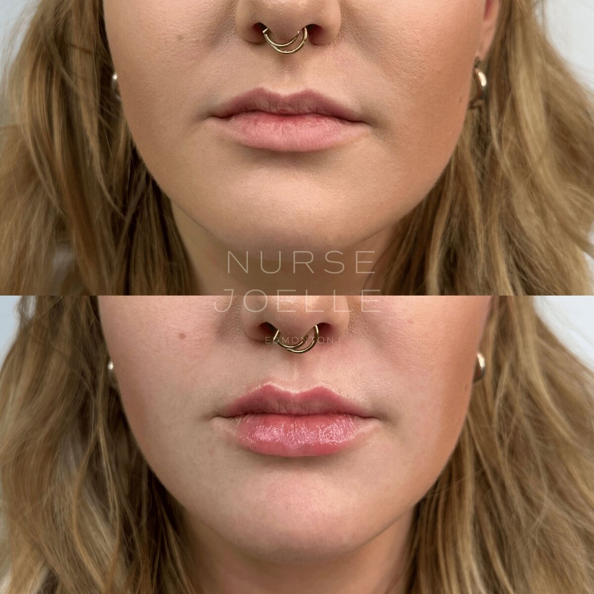 Nurse-Joelle-Cosmetic-Injectables-Before-and-After-10