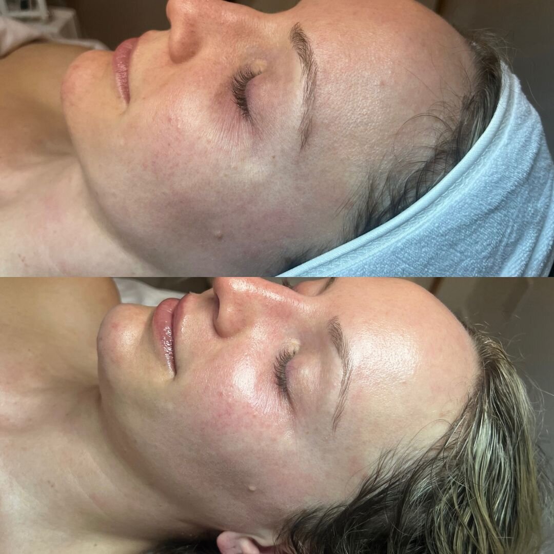 compressed-High-Touch-Medical-Grade-Facials-brand-and b-a-02