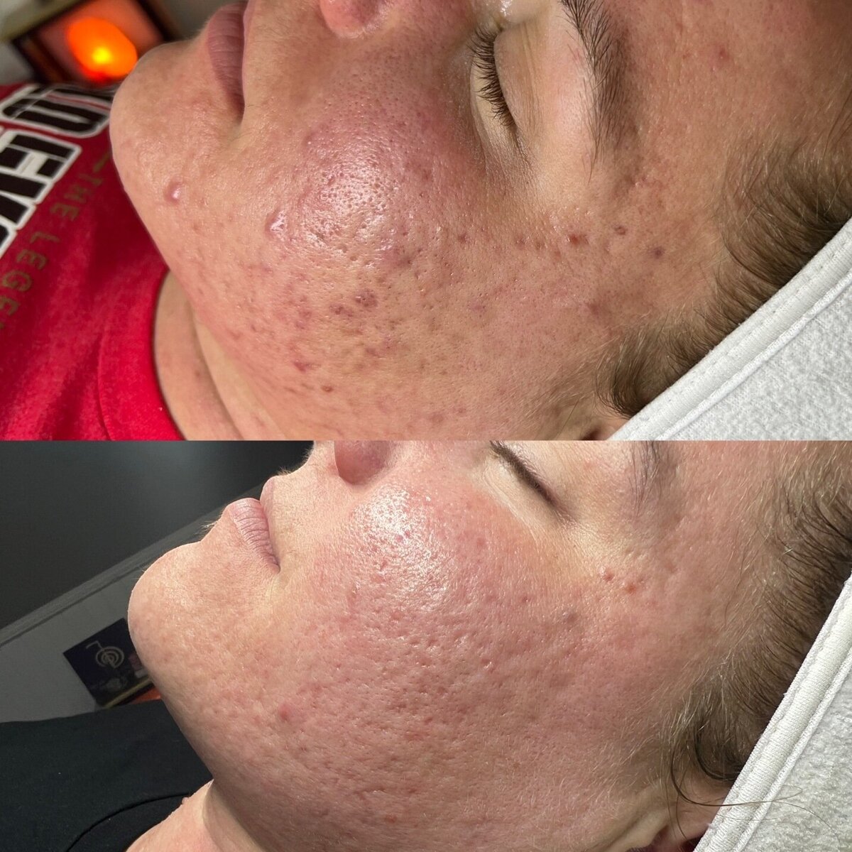 acne_solutions_ sacramento_ari_esthetics (2)