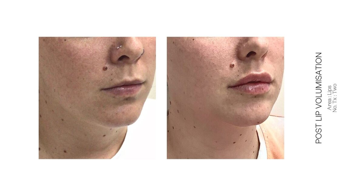 Best South Coast Lip Injection Before and After 35