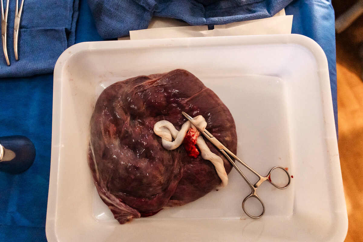  A placenta with clamps on the cord sits in a tray.  Modesto Doula, Shayna Cox, supported the mother prior to and during this labor. 