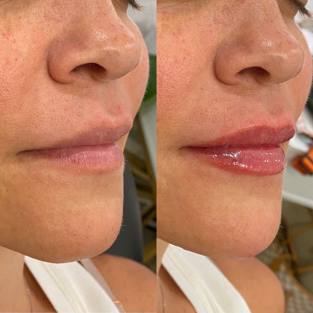 BalancedBeautyBotoxWestwood26