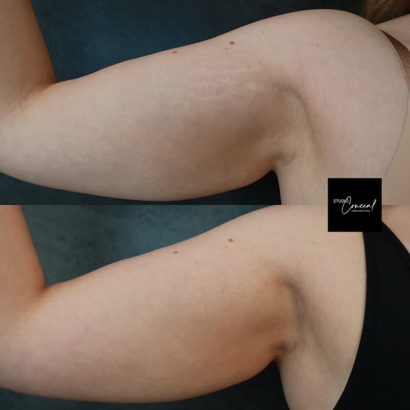 stretch-mark-arms-left-2