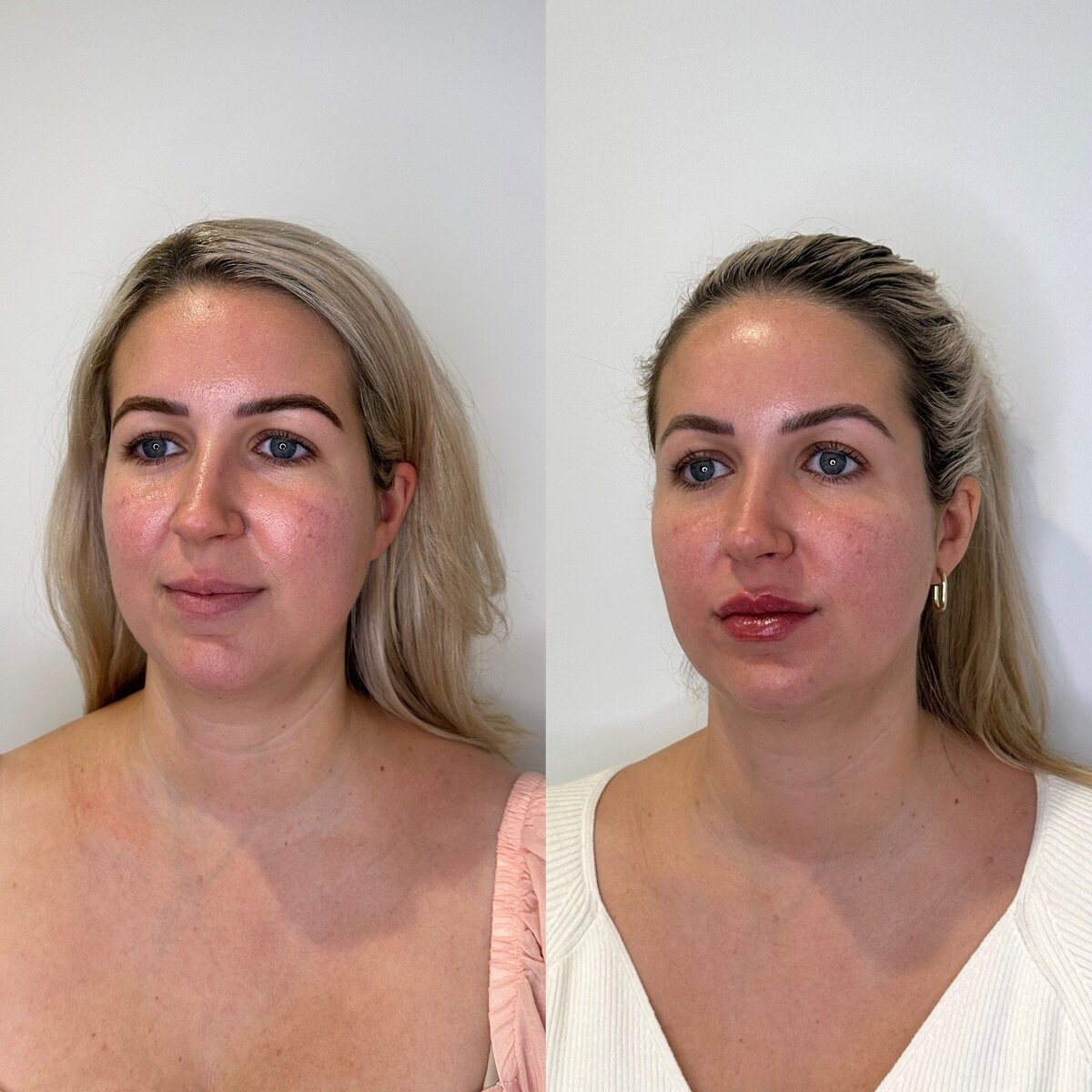 canova-aesthetics-med-spa-before-after-injectables-10