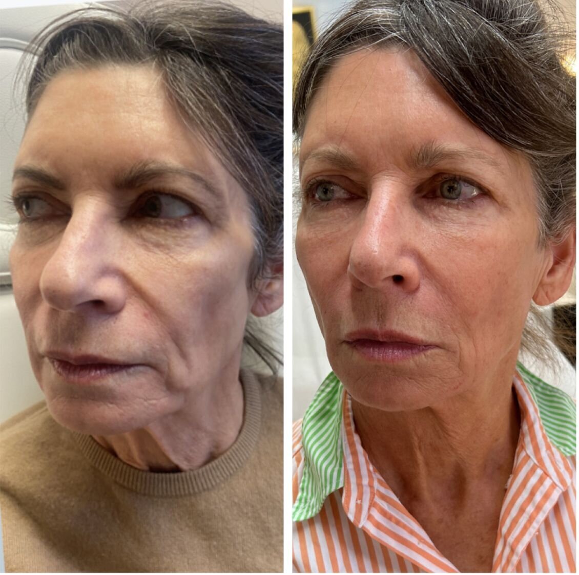 compressed-Hyperdilute-Radiesse-brand-and-before-after-11