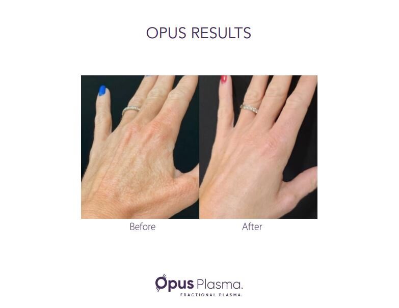 Opus Results Picture 9