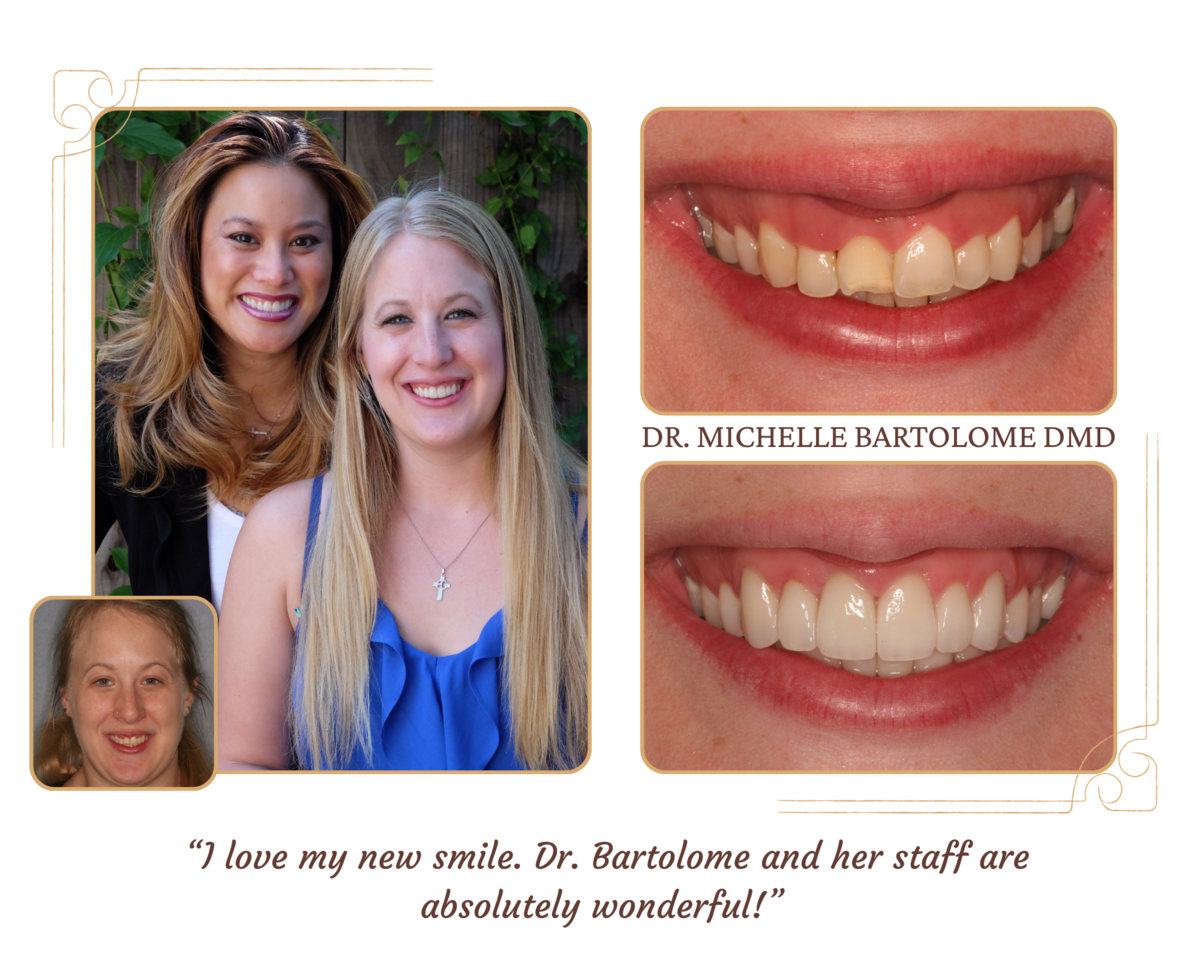 Crowns and Veneers