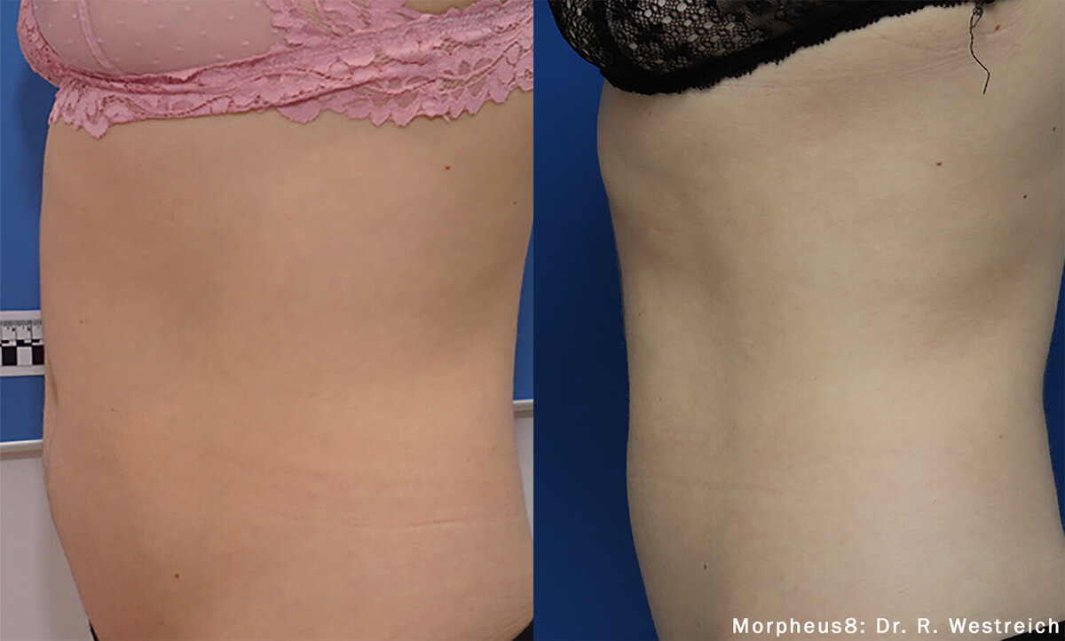 morpheus8-before-after-dr-r-westreich-preview-1