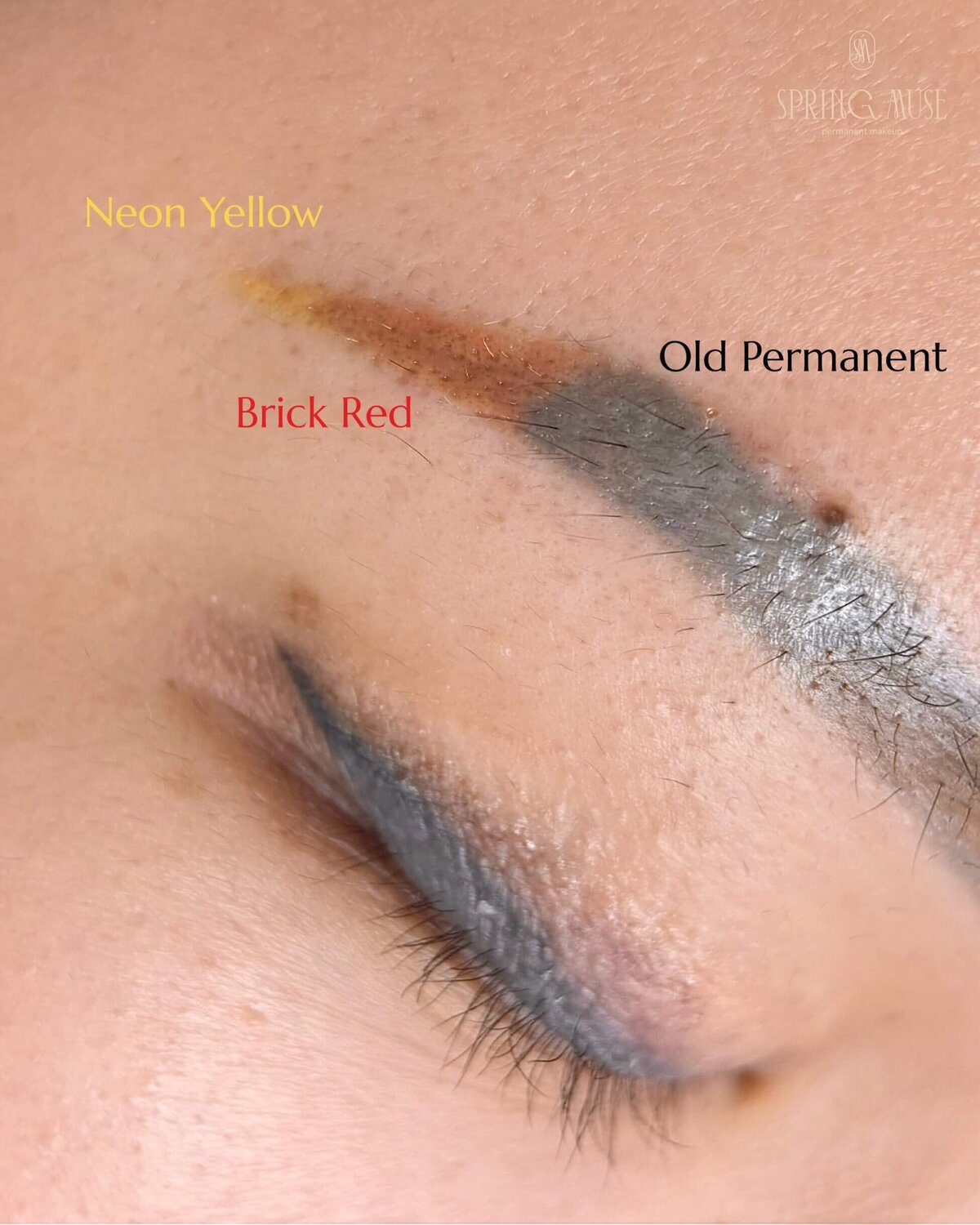 acid pmu removal nyc