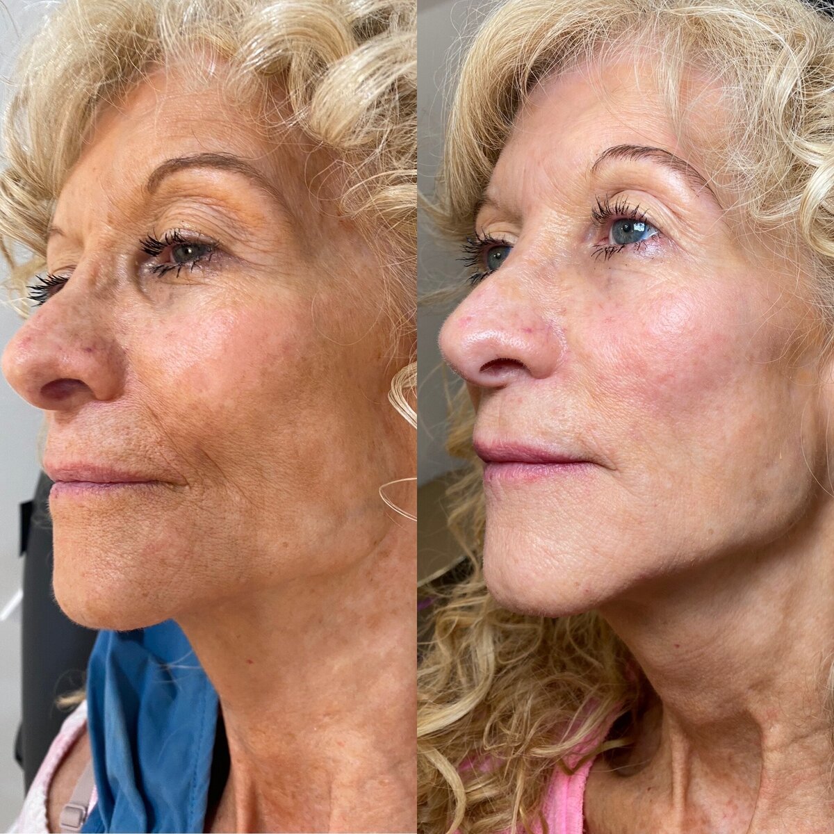 BalancedBeautyBotoxWestwood28