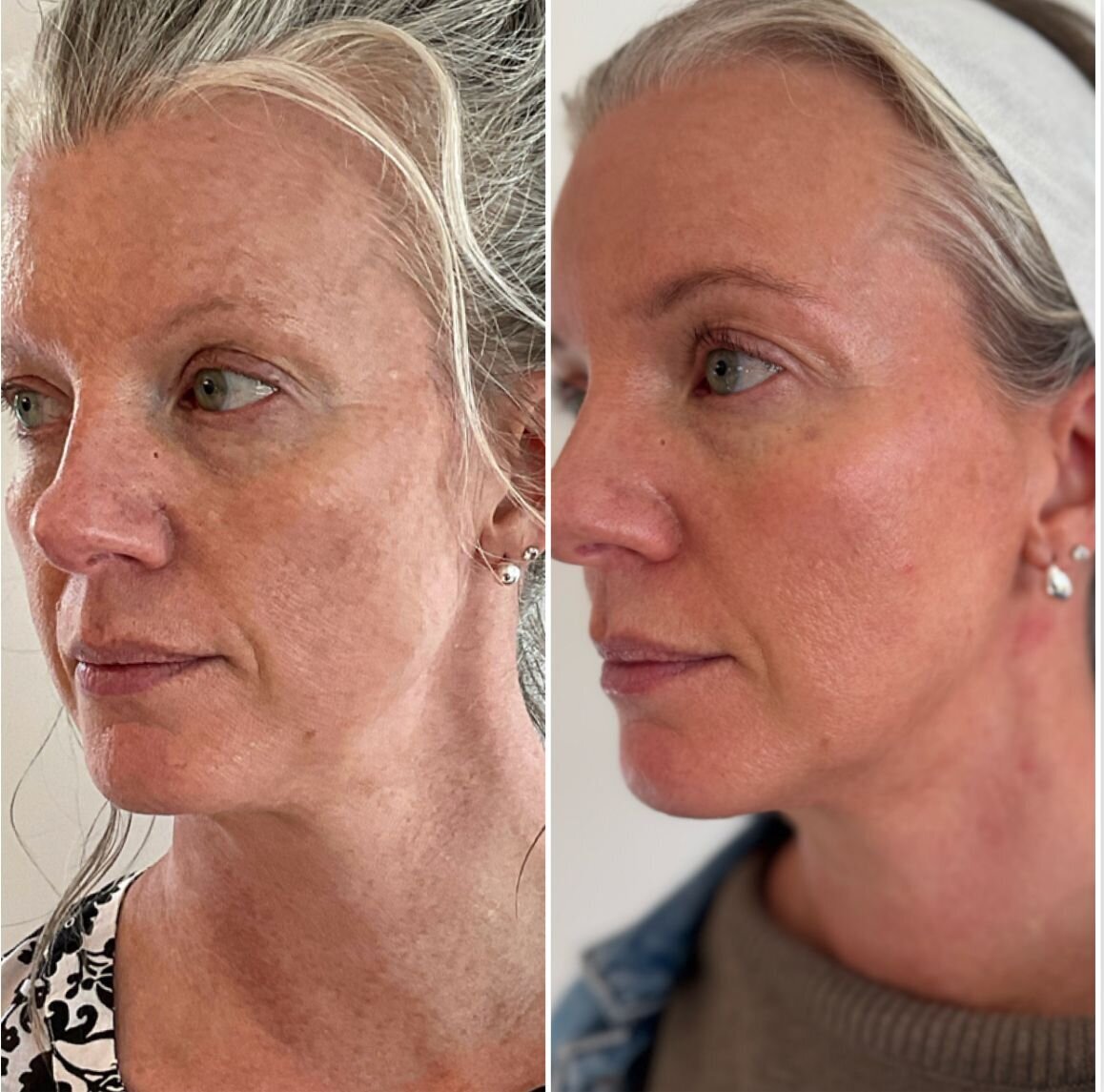 compressed-Moxi- BBL-before-after-12