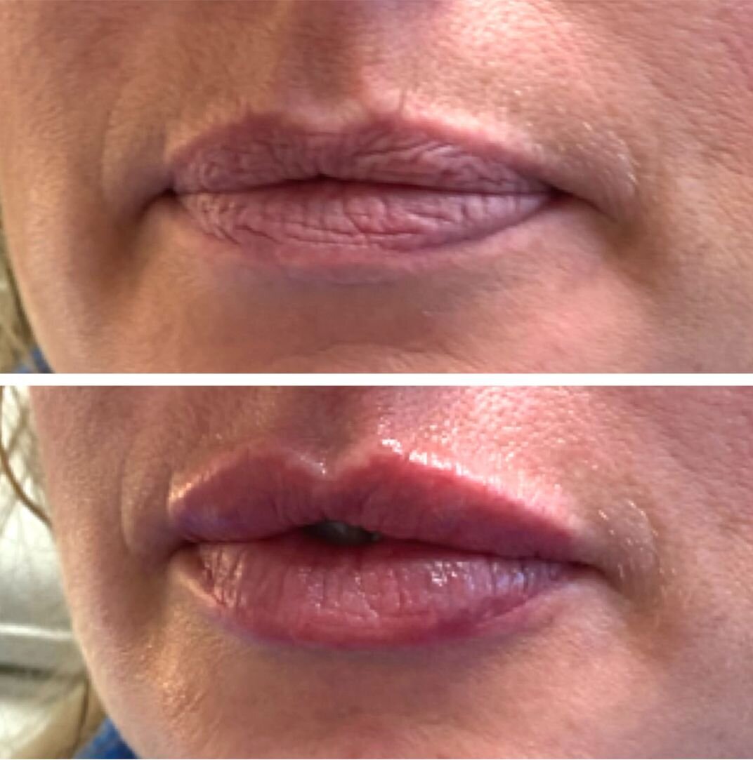 compressed-Lip-Wrinkles- Lip-volume-nd-some-brand-pics-04