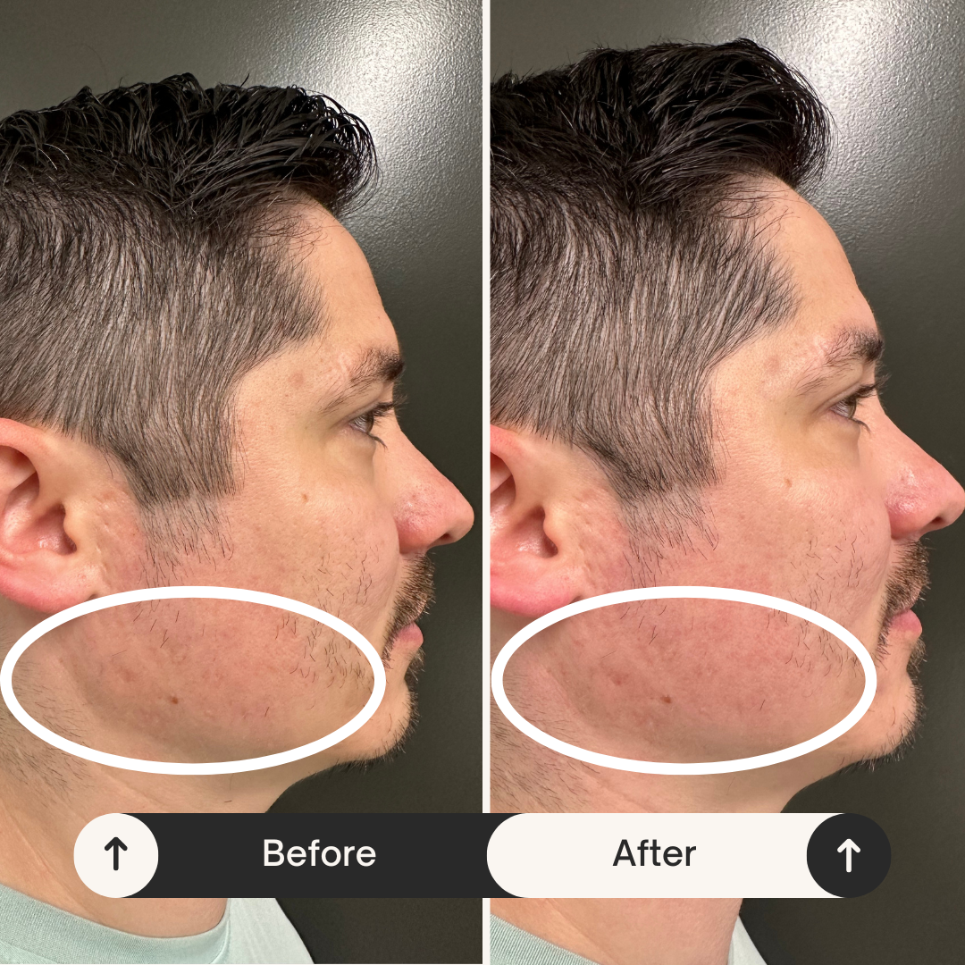 Buccal before after 2