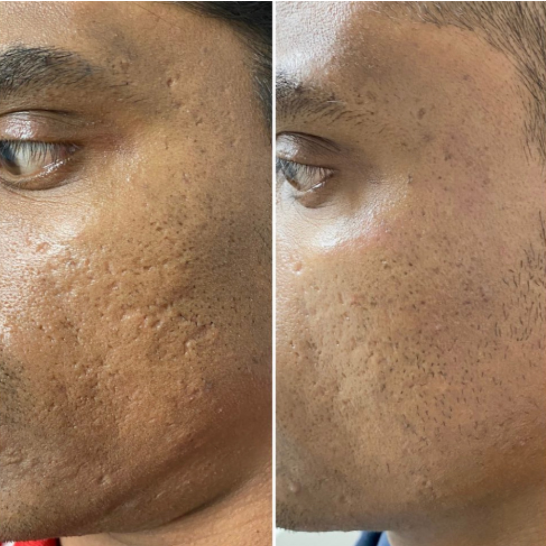 Microneedling w PRP - Acne Scars - 3 Sessions