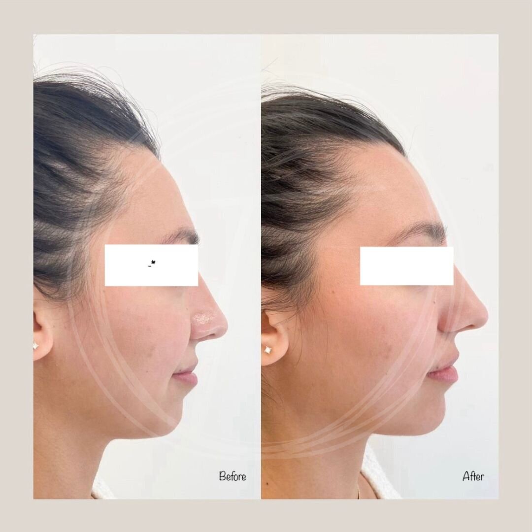 before:after results with look timeless - 11
