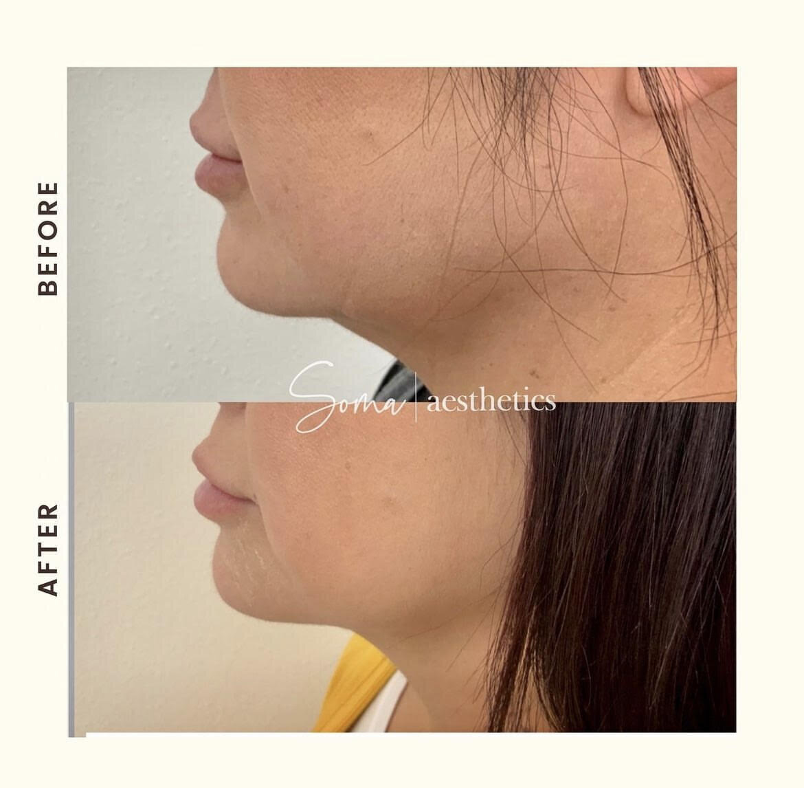 Kybella 
