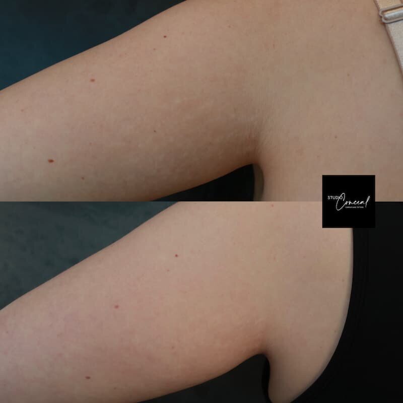 stretch-mark-arms-left-back-2