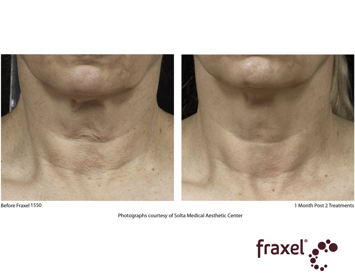 0504-Fraxel_1550_HiRes