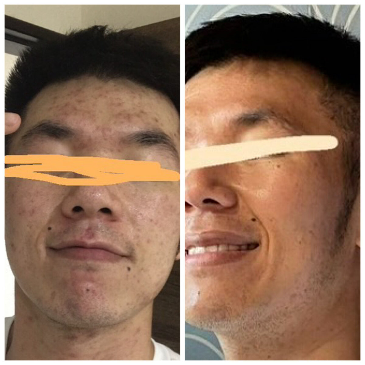 Clear skin transformation boosting confidence and emotional well-being for a rosacea graduate.