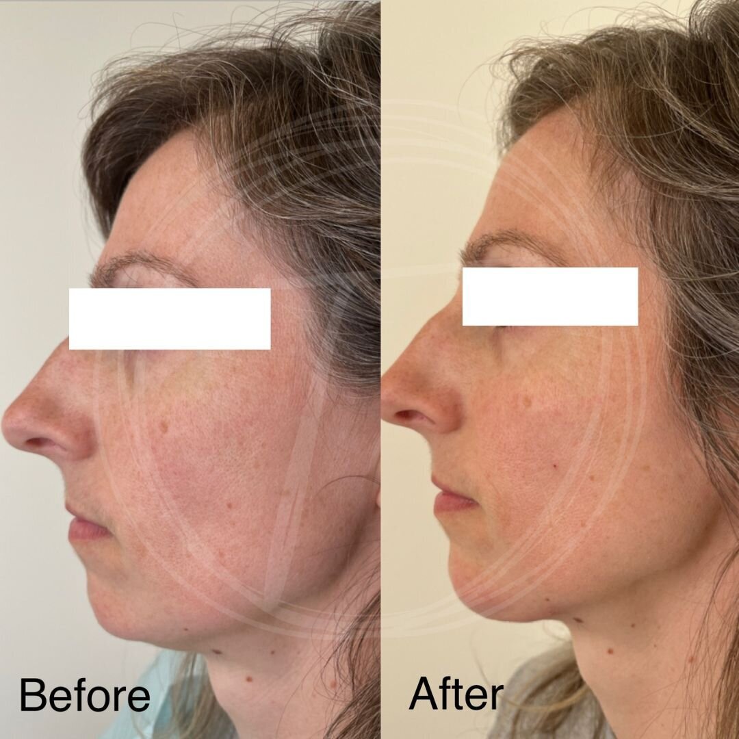 before:after results with look timeless - 2