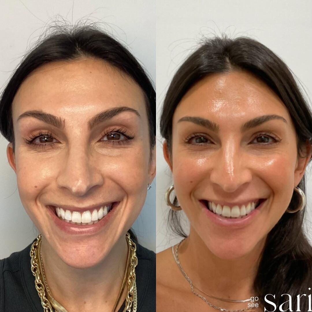 Botox_Beverly Hills_Go See Sari