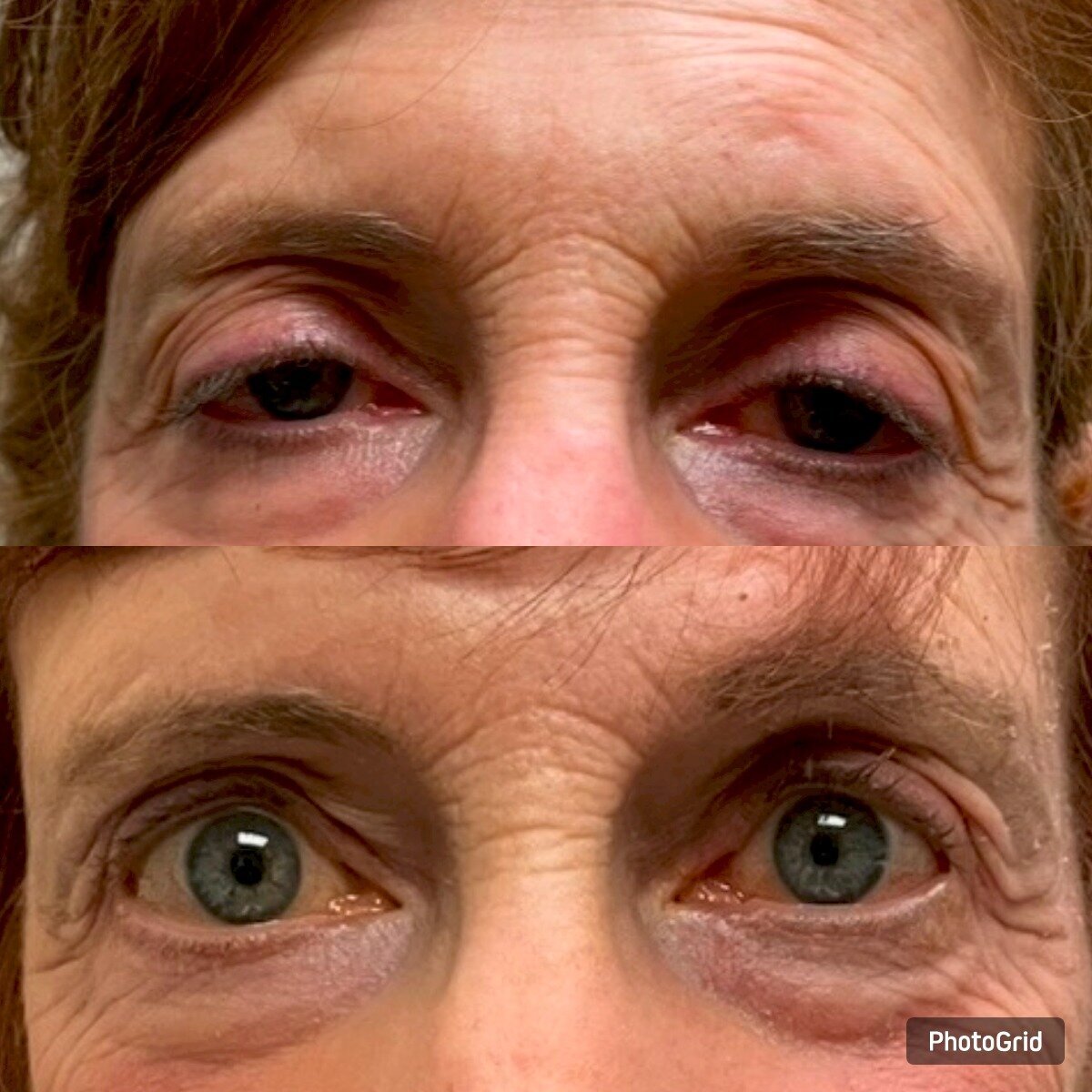 PTOSIS