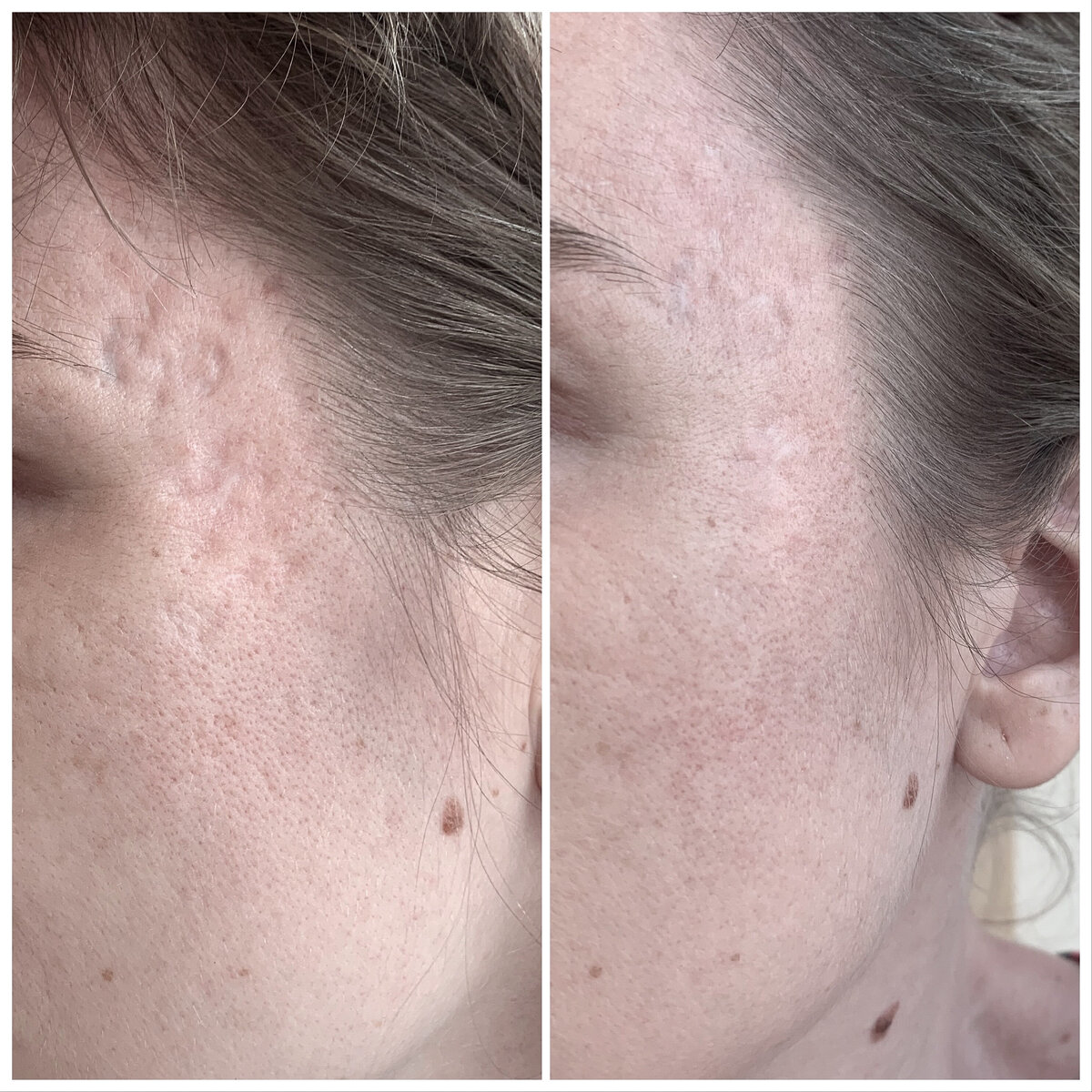 Fillers littekens cosmetisch arts Lizenka Adriaanse Rotterdam