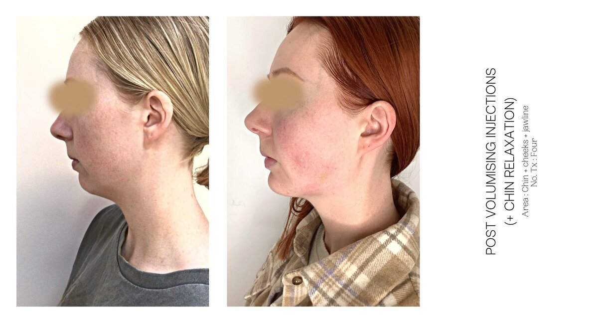 Cheek Injectable Before and After 4