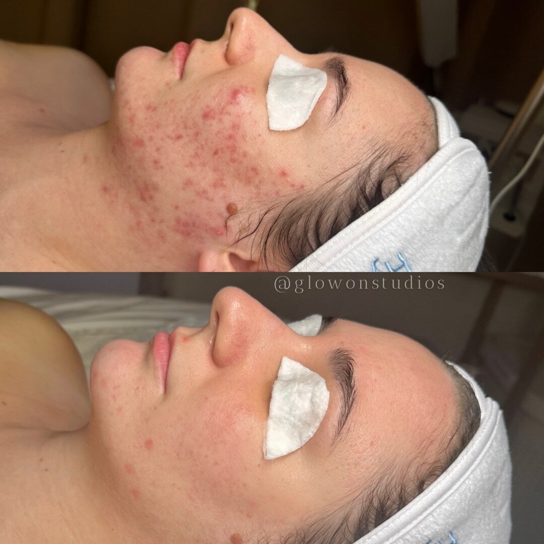 Glow-On-Studios-Before-After-Skincare-Sacramento-6